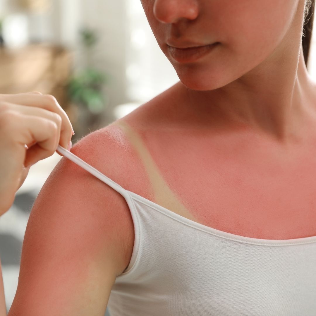 Prévention solaire : réduire les risques cutanés avant l’été